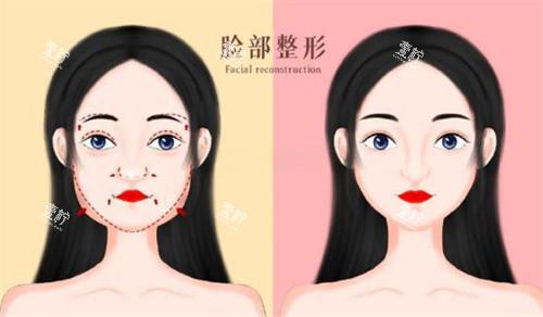 面部轮廓前后对比卡通图展示.jpg