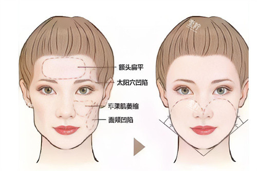 面部轮廓填充前后对比.jpg