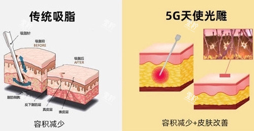 5G天使光雕对比传统吸脂.jpg