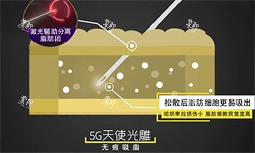 5G天使光雕吸脂.jpg