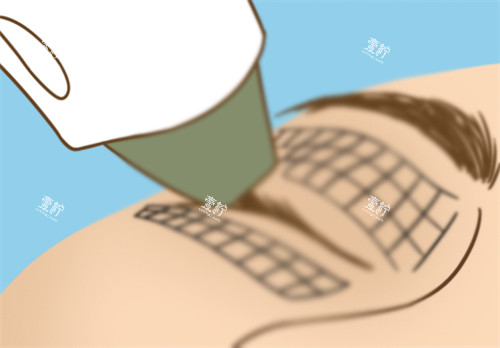 眼部热玛吉.jpg