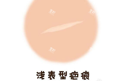 浅表型疤痕修复改善.jpg