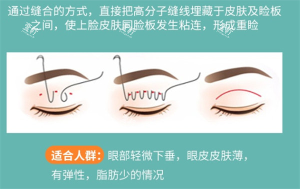 埋线双眼皮解析.jpg