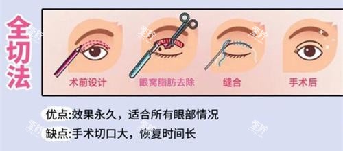 双眼皮手术全切法动画演示图.jpg