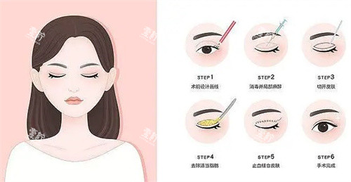 全切双眼皮过程卡通图.jpg