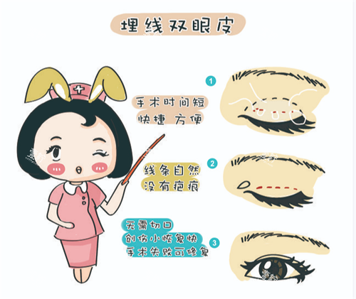 埋线双眼皮.png
