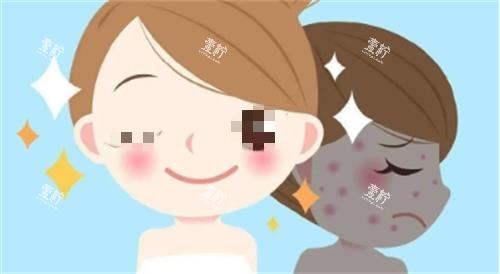 光子嫩肤成效图.png