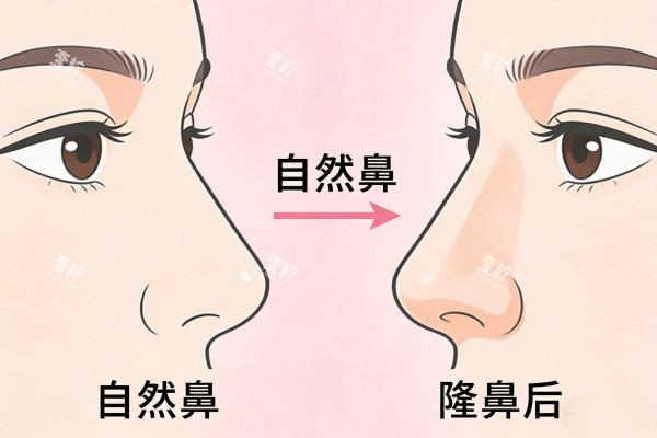 自然鼻型隆鼻前后对比图.jpg