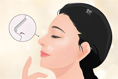 假体隆鼻卡通图.jpg