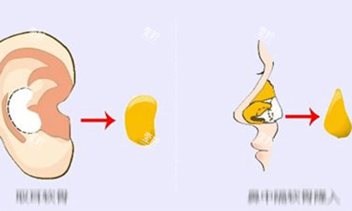 耳软骨隆鼻动画示意图.jpg