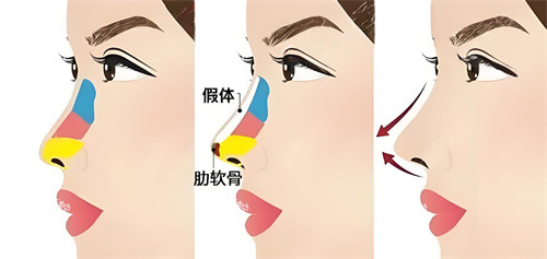 半肋骨隆鼻手术展示动画图.jpg