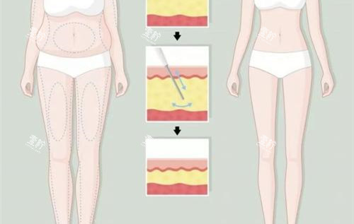 大腿环吸前后对比卡通示意图.jpg 大腿环吸前后对比卡通示意图.jpg
