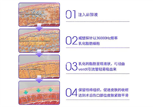 威塑吸脂手术步骤演示动画图.jpg 威塑吸脂手术步骤演示动画图.jpg