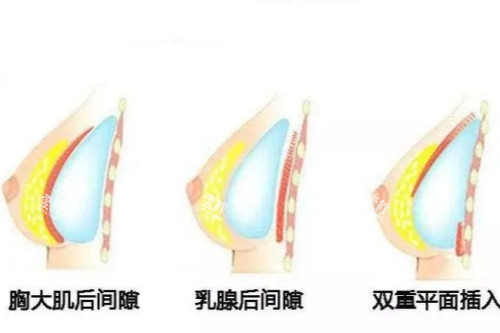 假体隆胸植入位置示意图.jpg
