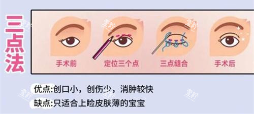 双眼皮手术三点法动画演示图.jpg