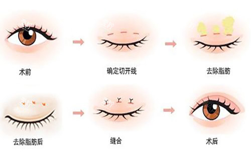 切开式双眼皮过程.jpg