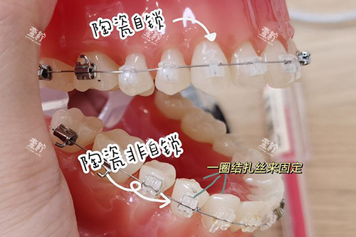 牙齿矫正陶瓷自锁托槽和非自锁牙套.jpg