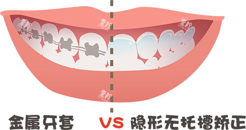 牙齿矫正牙套金属对比隐形牙套.jpg
