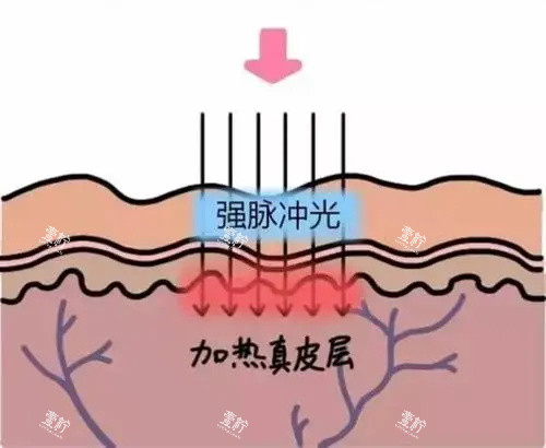 光子嫩肤针对的皮肤层.jpg