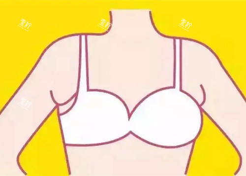 副乳位置卡通示意图 (2).jpg