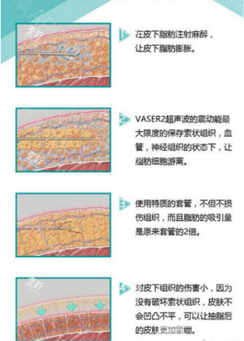 威塑手术机器与手术方式演示动画图.jpg