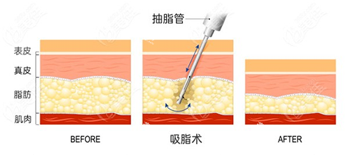 吸脂手术方法.png