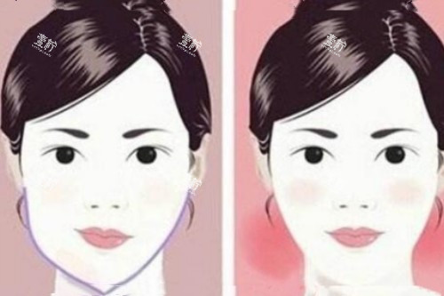 脸型不对称矫正前后对比图.jpg 脸型不对称矫正前后对比图.jpg