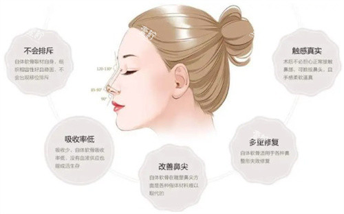 软骨隆鼻的优势.jpg