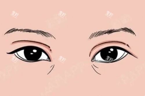 双眼皮失败卡通图 双眼皮失败卡通图