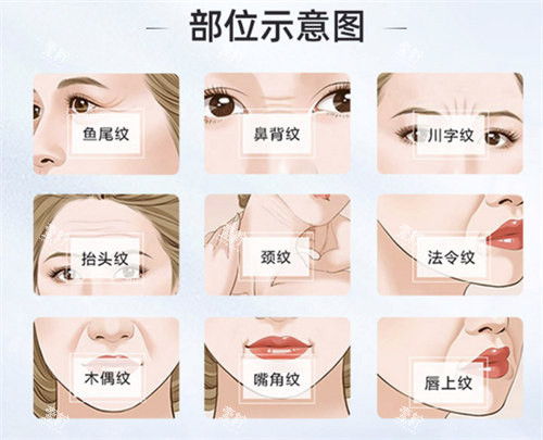 面部除皱部位演示动画图.jpg 面部除皱部位演示动画图.jpg
