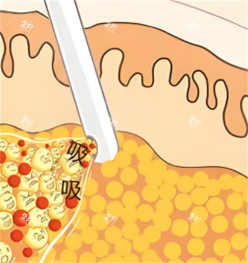 吸脂手术动画.jpg