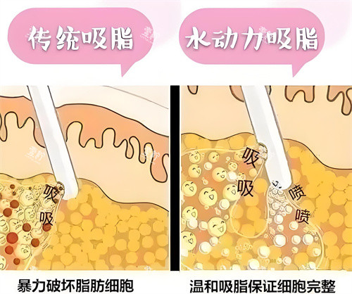 负压吸脂和水动力吸脂方式对比动画图.jpg