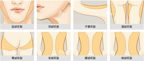 可以进行吸脂手术的部位展示动画图.jpg