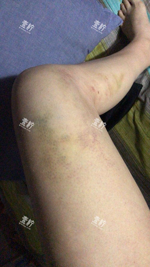 大腿吸脂术后淤青.jpg