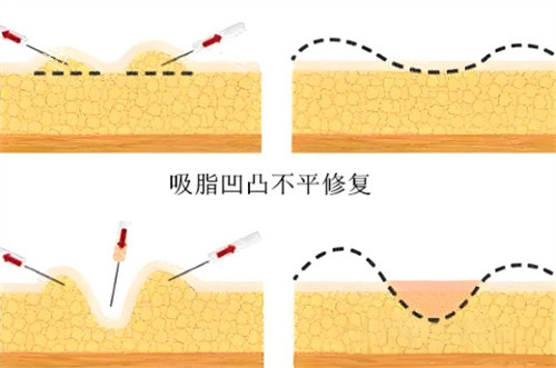 吸脂术后皮肤凹凸不平.jpg