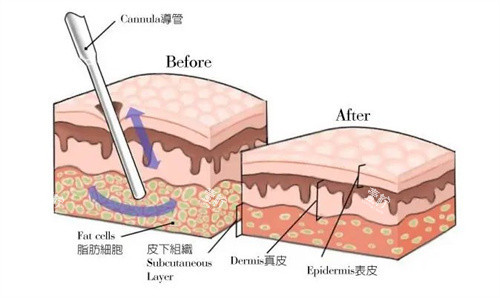 吸脂手术.jpg 吸脂手术.jpg