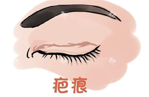 双眼皮术后疤痕.jpg 双眼皮术后疤痕.jpg