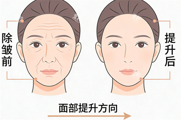 面部提升除皱前后对比.jpg 面部提升除皱前后对比.jpg
