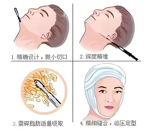 面部吸脂步骤动画演示图.jpg 面部吸脂步骤动画演示图.jpg