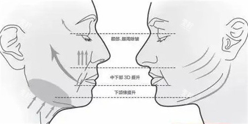 面部提升三大部位.jpg
