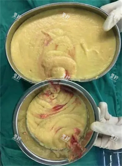 胸部不明注射物取出.jpg 胸部不明注射物取出.jpg