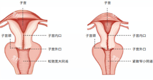 阴道紧缩术施术位置图解.jpg 阴道紧缩术施术位置图解.jpg