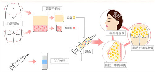 自体脂肪隆胸过程.jpg 自体脂肪隆胸过程.jpg