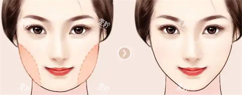 面部吸脂.jpg 面部吸脂.jpg