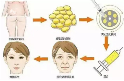 自体脂肪填充过程图解.jpg
