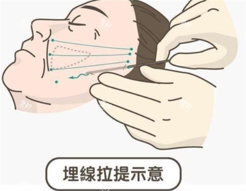 埋线提升面部的操作过程.jpg