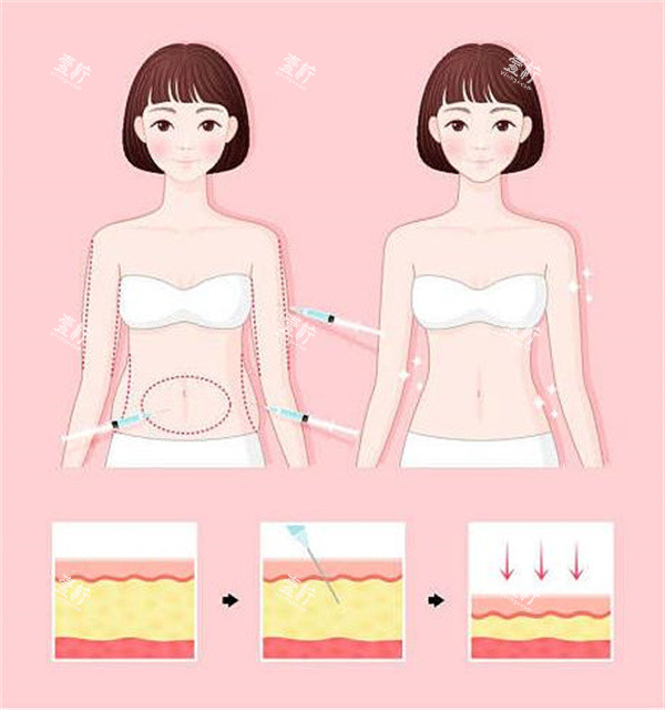 腰腹吸脂对比.jpg