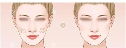 面部填充对比图.png 面部填充对比图.png