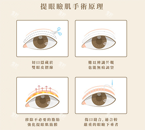 双眼皮失败修复提升眼肌手术.jpg