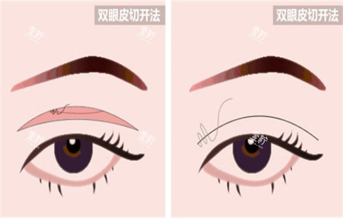 全切双眼皮手术的切口部位.jpg